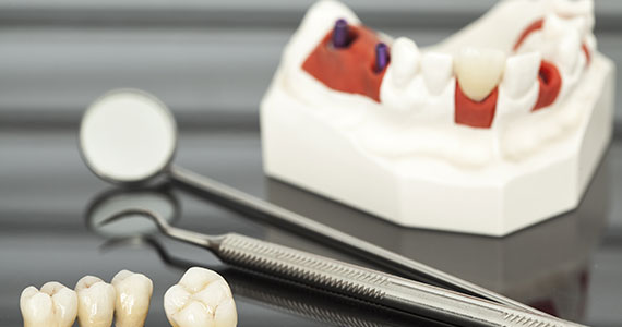 Crowns, Bridges & Veneers | Brisbane