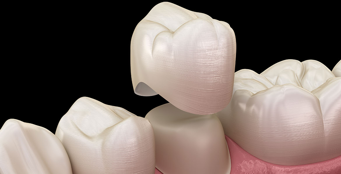 Crowns, Bridges & Veneers | Brisbane | Hawthorne Dental