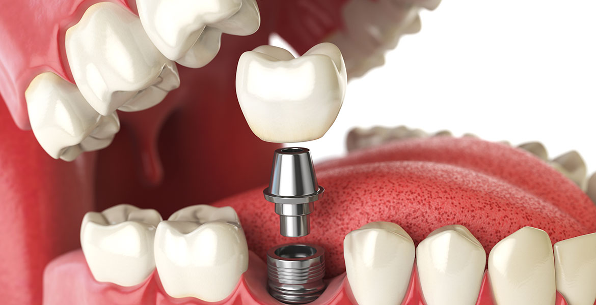 Implants | Brisbane | Hawthorne Dental